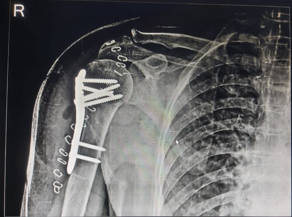 Shoulder Arthroscopy